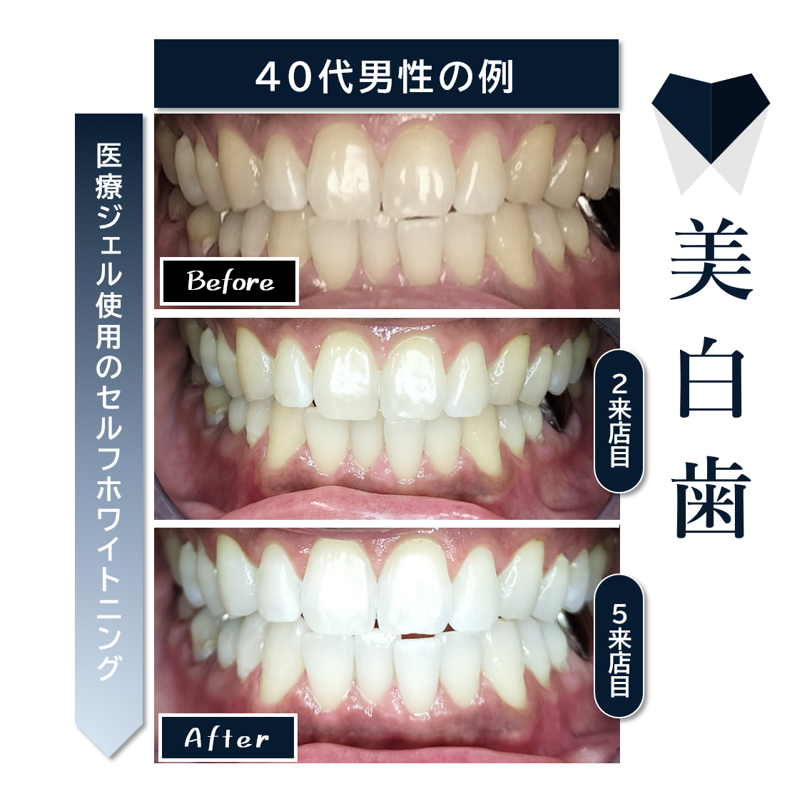 大阪｜歯を白くする医療タイプのセルフホワイトニングサロン HAKUTO（ハクト）寝屋川